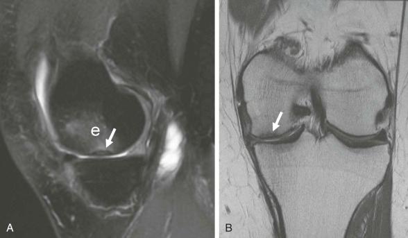 eFIGURE 110-3, Subchondral fracture. Some weeks after partial medial meniscectomy, this patient's sudden onset of pain was the result of a subchondral fracture. Sagittal, fat-suppressed MR image ( A ) better shows the high signal intensity of the bone marrow edema (e) associated with the fracture, which is shown by the low signal intensity line ( B ) ( arrow also in A ).