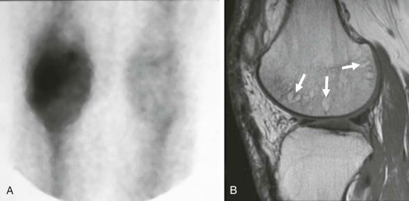 eFIGURE 110-4, Complex regional pain syndrome (reflex sympathetic dystrophy). Blood pool images from a bone scintiscan ( A ) show diffuse uptake around the knee. Sagittal, intermediate echo-time MR image ( B ) shows patchy, rounded periarticular foci of relative increased signal (arrows) that appear to be associated with complex regional pain syndrome.