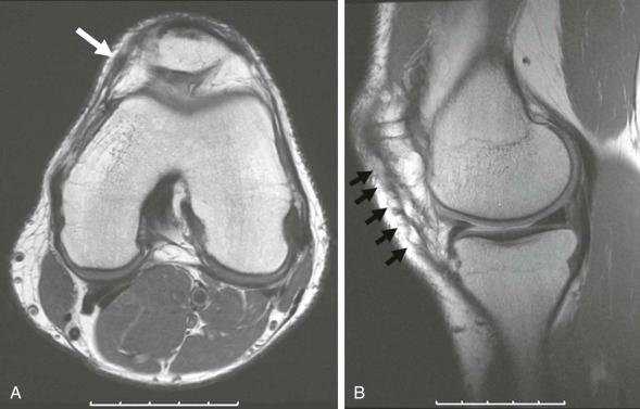 eFIGURE 110-5, Arthrotomy scar. Axial ( A ) and sagittal ( B ) MR images show scar from medial arthrotomy ( white arrow and black arrows ) for cartilage repair. The scar is similar to that for arthroscopy but more extensive.