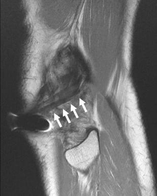 eFIGURE 110-6, Extra-articular stabilization. Sagittal MR image through the lateral side of the knee showing an extra-articular graft (arrows) that was used to stabilize the knee after the ACL tear, before constructions were commonly performed. ACL, Anterior cruciate ligament.