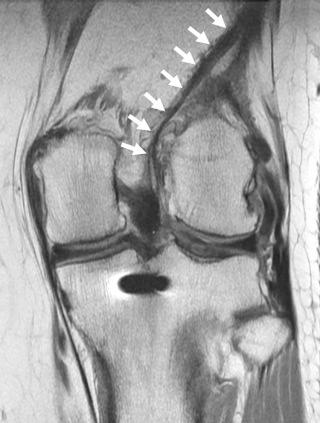 FIGURE 110-1, Iliotibial band autograft for ACL reconstruction. Coronal, intermediate echo-time MR image shows ACL autograft with iliotibial band (arrows). This technique was popular in the 1970s. The only way to know that the reconstruction was done with an iliotibial band is to follow the structure over sequential images. ACL, Anterior cruciate ligament.
