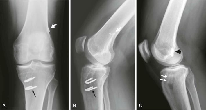 FIGURE 110-2, ACL reconstruction. Radiographs show the different types of fixation: staples ( A and B ) (thin black arrows), buttons ( A , short white arrow), and screws ( C ) (black arrowhead). Some devices, such as bioabsorbable screws ( C , small white arrows) are not easily visible on radiography. Sometimes, the bone plug of a bone-patella-bone construct can be seen. On the frontal view, the graft should be angulated about 15 degrees. On the lateral view, the tibial tunnel should be at the posterior aspect of the anterior tibial spine. ACL, Anterior cruciate ligament.