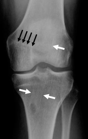 FIGURE 110-3, Transverse fixation. Some surgeons prefer a transverse fixation. Frontal radiograph in a patient with ACL reconstruction shows tibial tunnel and lateral wall of the femoral tunnel. A transverse lucency represents a bioabsorbable fixation device of the proximal graft (small black arrows). ACL, Anterior cruciate ligament.