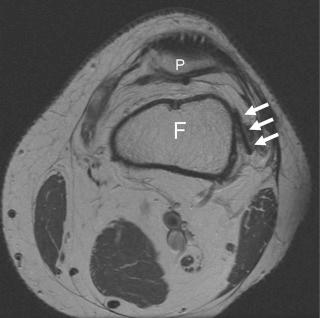 FIGURE 110-4, EndoButton. Axial MR image at the level of the distal femur (F) shows the radiolucent EndoButton (arrows), which can be used for fixation of cruciate ligament reconstructions. The graft is tied through the button with a suture, but the button is too large to pull back through the graft's tunnel. The top of the patella (P) is visible.