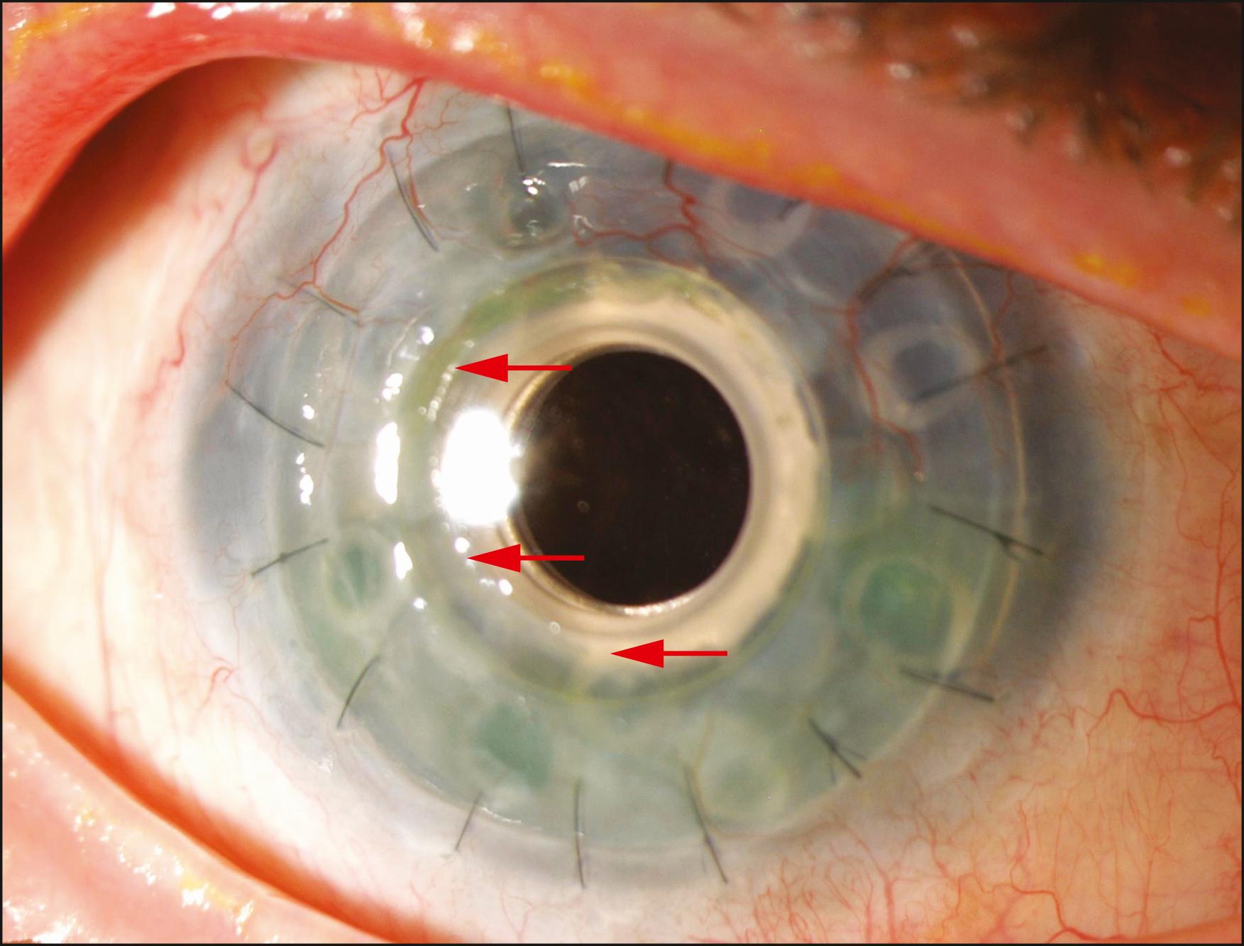 Fig. 157.5, Corneal epithelium growing over the edge of the Boston keratoprosthesis type 1 front plate (arrows) .