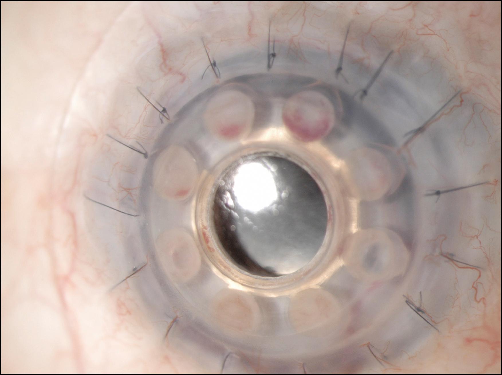 Fig. 157.7, Opacification of the posterior plate fenestrations and development of a retroprosthetic membrane.