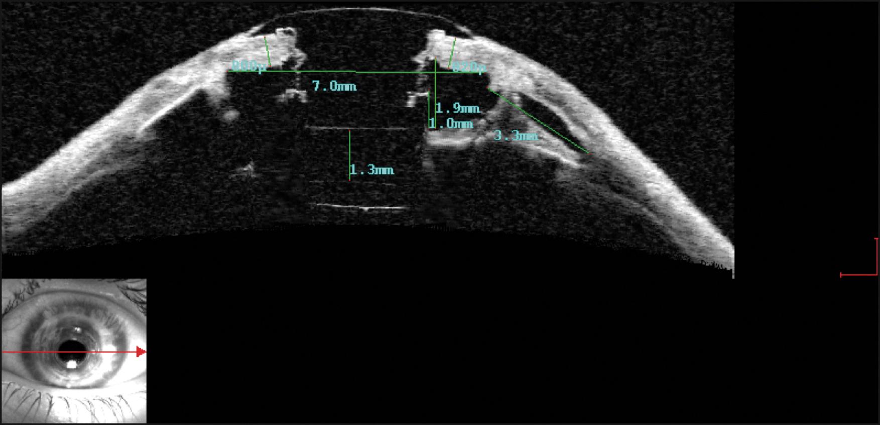 Fig. 157.8, Anterior segment optical coherence tomography after keratoprosthesis surgery.