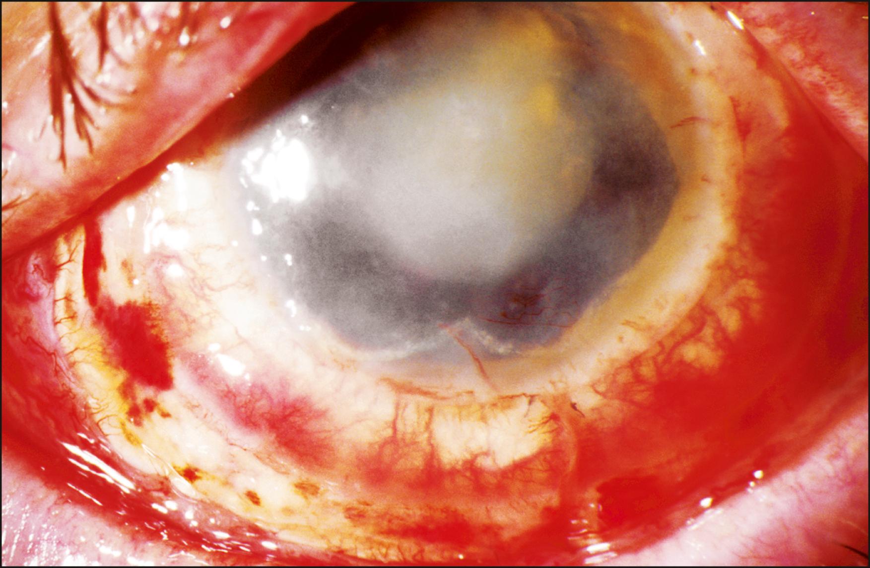 Fig. 169.2, Acute limbal allograft rejection. The patient had a keratolimbal allograft two months earlier. Note swollen and inflamed limbal tissue with neovascularization. Also note the presence of an epithelial rejection line inferiorly.