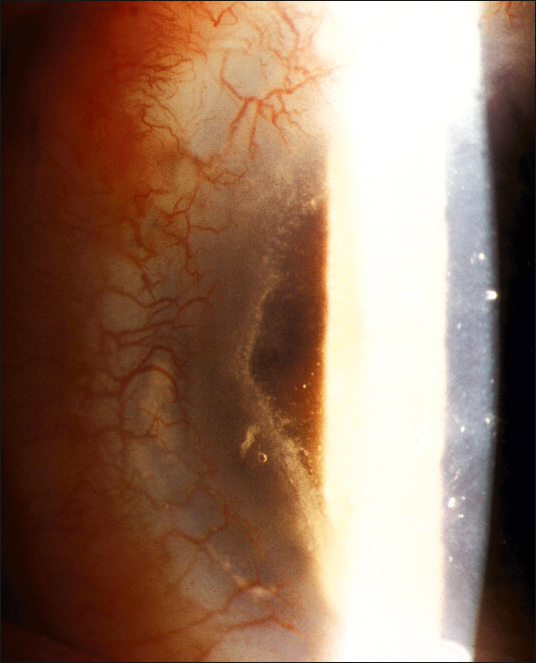 Fig. 169.3, Acute stem cell rejection demonstrating an epithelial rejection line.