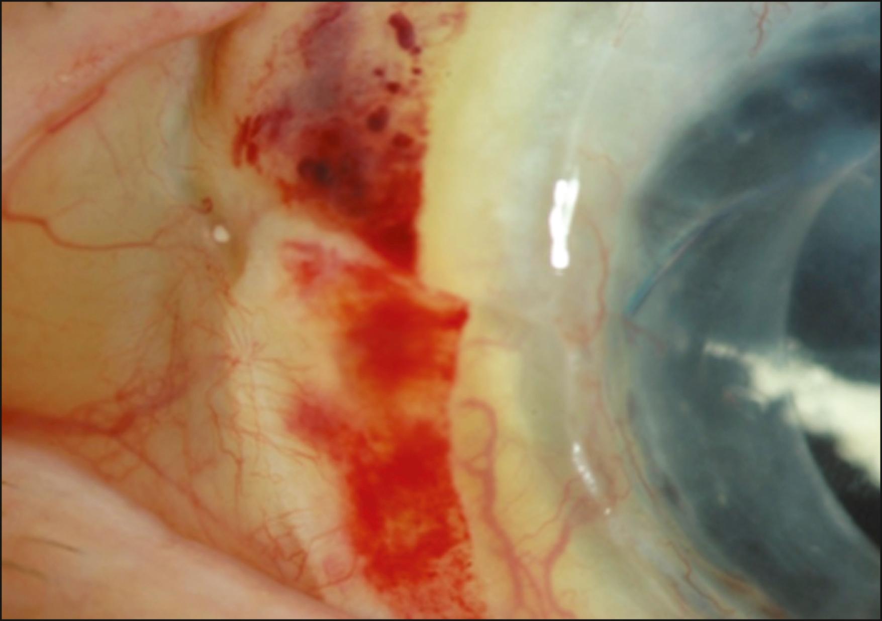 Fig. 169.4, A 71-year-old female with history of keratolimbal allograft for aniridia who had been off immunosuppression developed new subconjunctival hemorrhage and injection after skin exposure to poison ivy while gardening. The findings are consistent with early low-grade rejection, which resolved after treatment by oral and topical prednisone.