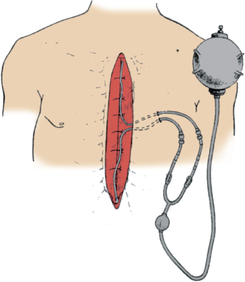 Fig. 33.1, Intraoperative placement of the pressurized elastomeric pump and catheters.