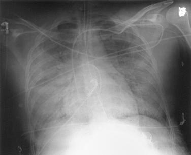 Fig. 171.1, Chest radiograph showing diffuse bilateral infiltrates, consistent with acute respiratory distress syndrome.
