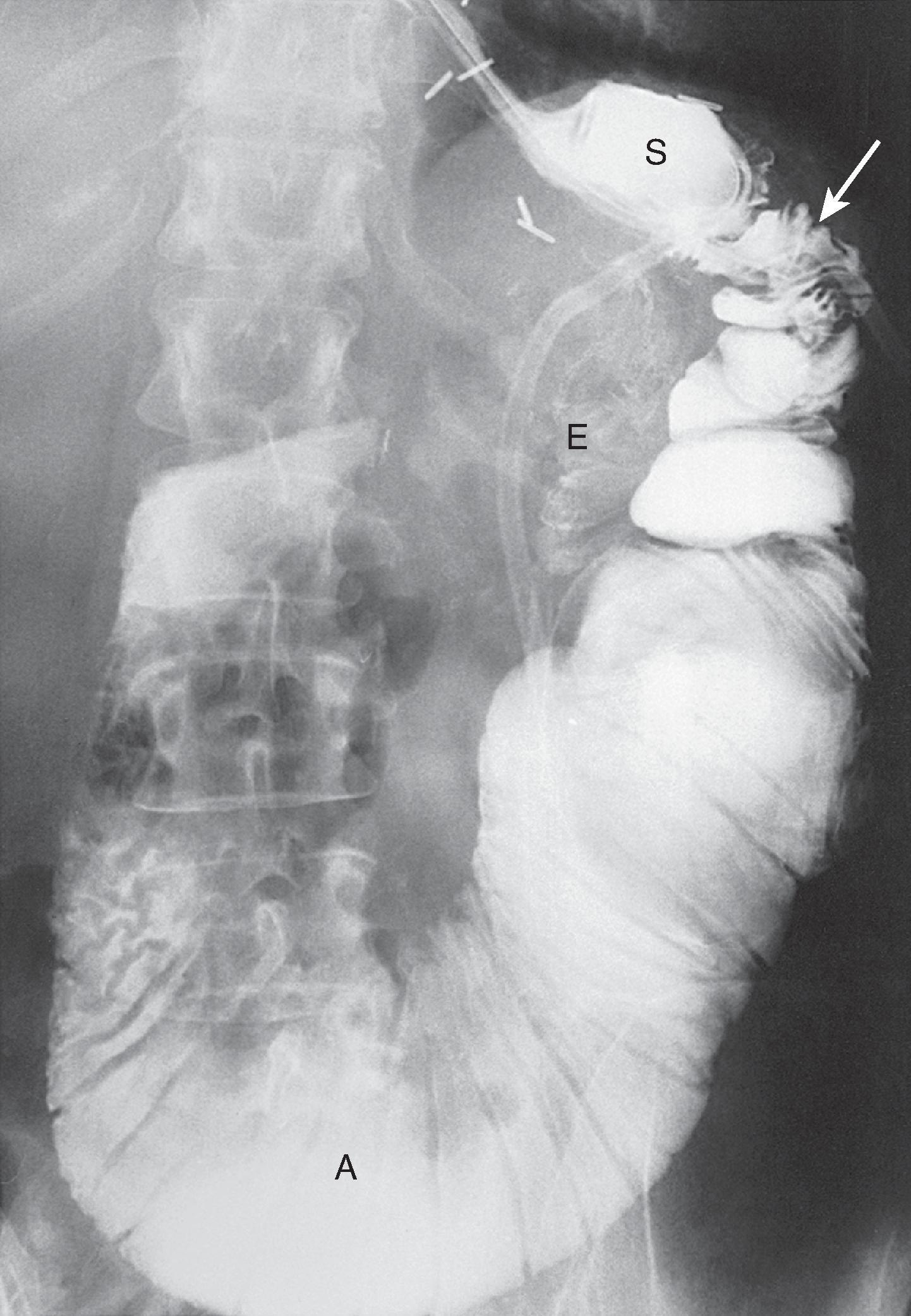 Fig. 34.1, Afferent loop obstruction after Billroth II with gastrojejunostomy.