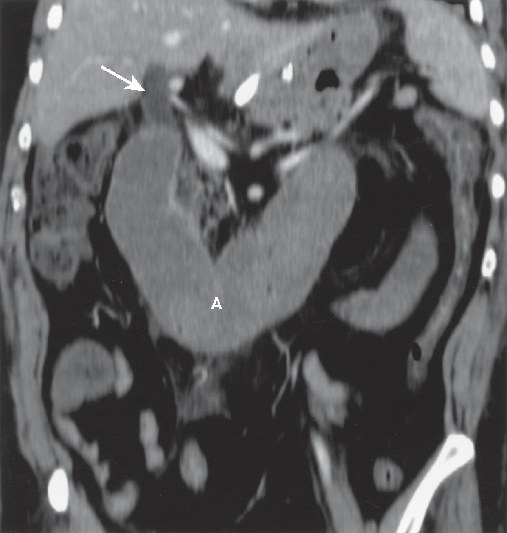 Fig. 34.2, Afferent loop obstruction after total gastrectomy with Roux-en-Y esophagojejunostomy.