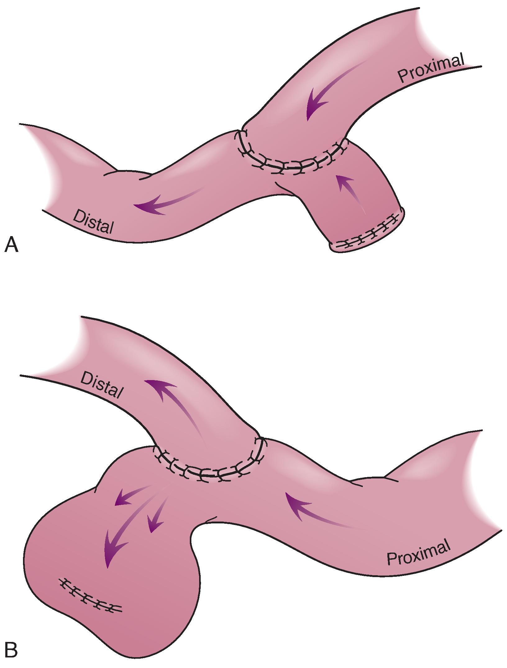 Fig. 34.3, End-to-side anastomosis.