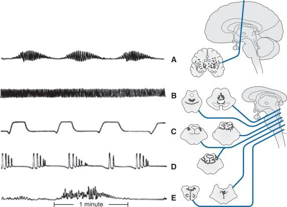 Fig. 23.1, Abnormal respiratory patterns associated with pathologic brain lesions. A, Cheyne–Stokes respiration. B, Central neurogenic hyperventilation. C, Apneustic breathing. D, Cluster breathing. E, Ataxic breathing.