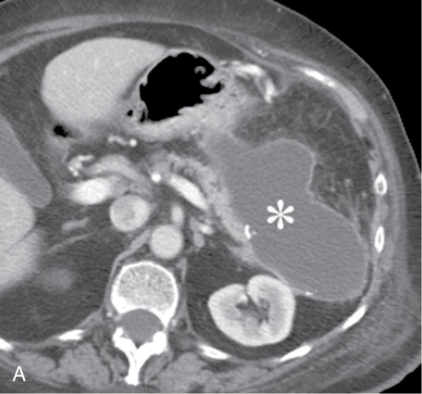 FIGURE 28.1, A 77-year-old female patient after distal pancreatectomy for neuroendocrine tumor.