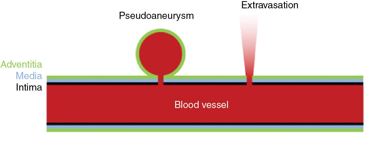 FIGURE 28.2, A pseudoaneurysm is a contained arterial rupture, which can bleed intermittently. On angiogram or computed tomography (CT) angiogram, it looks like a round enhancing structure. On the other hand, active extravasation of contrast looks like a jet of contrast on angiography, which continues to spread on delayed images.