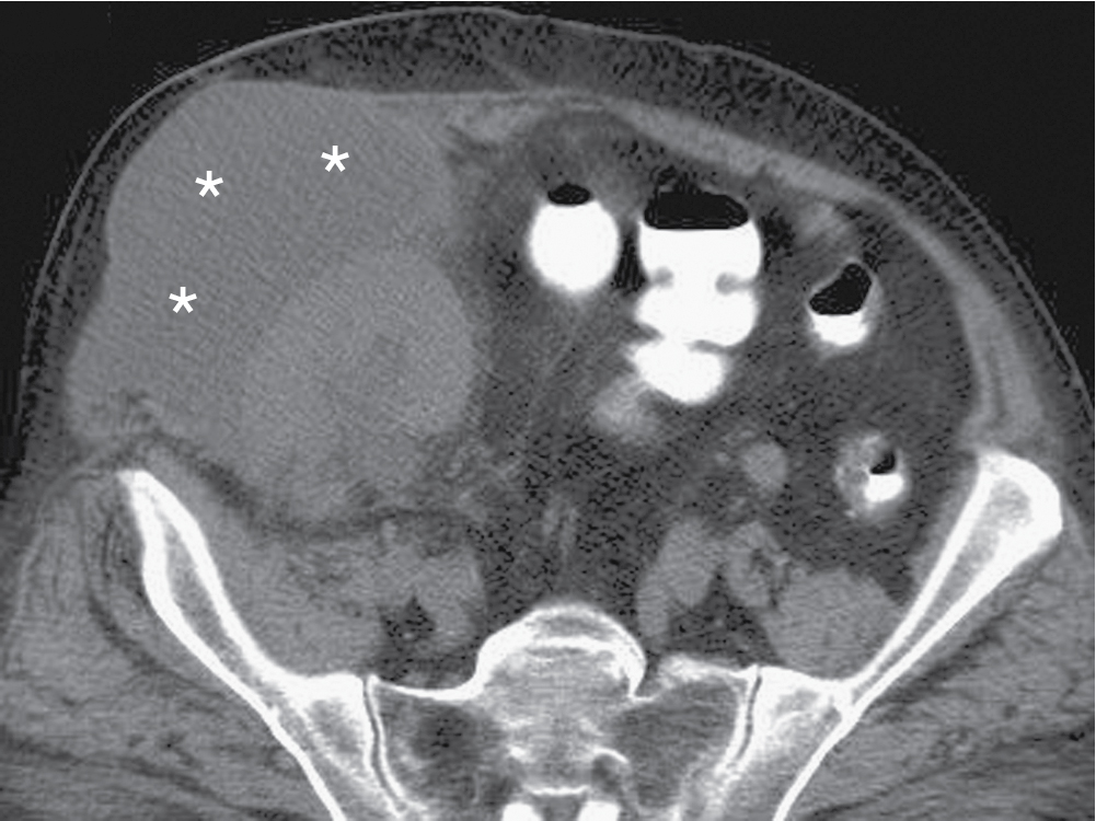 Fig. 37.1, Abdominal wall seroma. Axial unenhanced computed tomography image of the abdomen shows an abdominal wall fluid collection (seroma, asterisks ), located superficial to a renal transplant in the right iliac fossa.