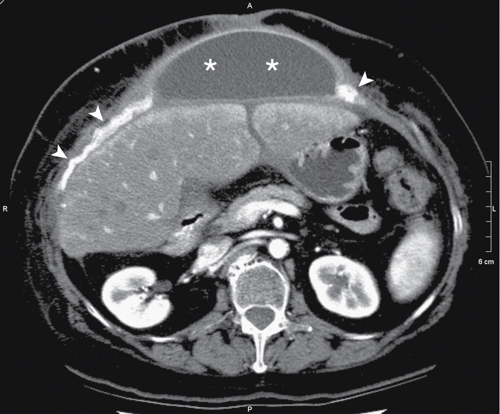 Fig. 37.2, Abdominal wall seroma and mesh. Axial contrast enhanced computed tomography image of the abdomen demonstrates a well-defined ventral wall seroma ( asterisks ), manifesting after ventral hernia repair with mesh ( arrowheads ), in a 51-year-old man.