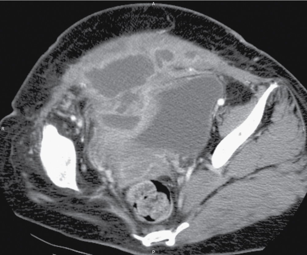 Fig. 37.3, Abdominal wall abscess. Axial contrast-enhanced computed tomography image of the abdomen shows a complex pelvic collection extending into the abdominal wall in a 41-year-old woman that was secondary to pelvic inflammatory disease.