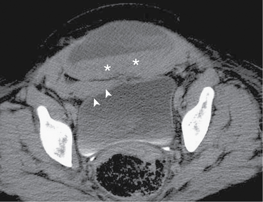 Fig. 37.4, Abdominal wall hematoma. Axial contrast-enhanced computed tomography image of the abdomen demonstrates a hematoma in the anterior abdominal wall in a 32-year-old woman after cesarean section. The hematoma is below the arcuate line, demonstrates hematocrit effect ( asterisks ), and is associated with extraperitoneal extension of the hematoma into the space of Retzius ( arrowheads ).