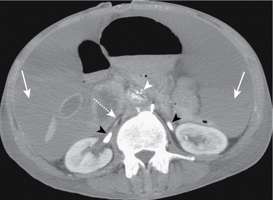 Fig. 37.6, Hemoperitoneum in a 57-year-old diabetic man who had laparotomy for infective aortitis. The patient became hypotensive after aortic graft placement. This axial computed tomography image shows aortic graft ( white arrowhead ), collapsed inferior vena cava ( dashed arrow ), and evidence of layered hemoperitoneum ( solid arrows ), indicating massive peritoneal bleeding. Bilateral ureteral stents ( black arrowheads ) are seen. Intravesical pressure was elevated at 28 mm Hg, indicating elevated intraabdominal pressure in keeping with abdominal compartment syndrome. Emergency decompressive laparotomy was performed, and the patient survived.