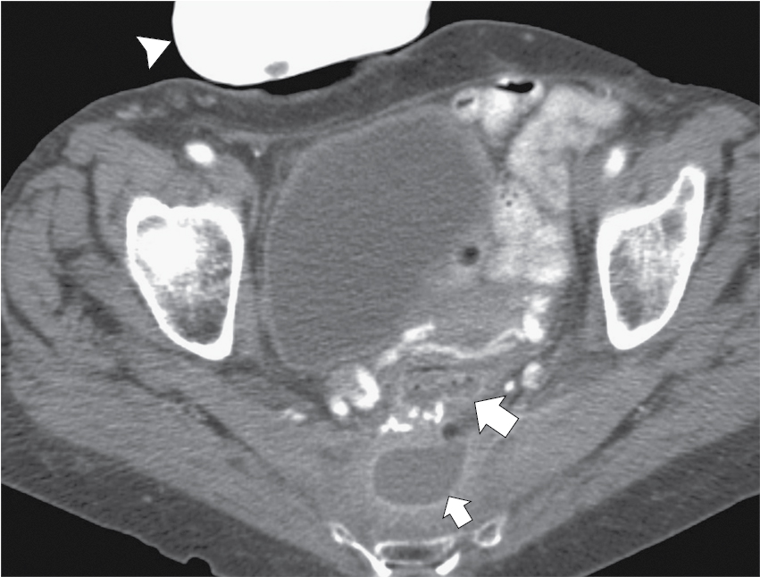 Fig. 37.7, Axial contrast-enhanced computed tomography in a 69-year-old man with anterior resection ( arrow ) for rectal cancer and now a postoperative fluid collection in the presacral space ( small arrow ), which was found to be infected after percutaneous aspiration. There is a defunctioning colostomy bag present ( arrowhead ).