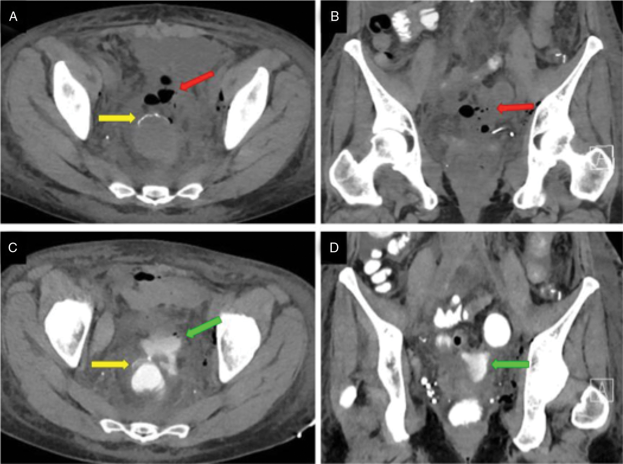 Fig. 37.8, 50-year-old female with metastatic ovarian cancer who is postoperative day 3 following radical hysterectomy, bilateral salpingo-oophorectomy, omental/peritoneal cytoreduction, and resection of rectosigmoid metastasis. A, B, Axial and coronal computed tomography (CT) at the level of the rectosigmoid anastomosis shows loculated foci of gas ( red arrow ) anterior to the suture line ( yellow arrow ). The possibility of an anastomotic leak was raised, but could not be confirmed because enteric contrast had only reached the distal ileum. C, D, Axial and coronal CT was performed 4 hours later at the same level, now clearly demonstrating extravasation of contrast into the peritoneum ( green arrow ). Patient was subsequently taken to the operating room where a defect anterior to the suture line was repaired.