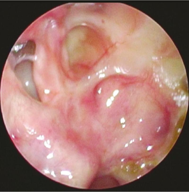 Fig. 38.1, Endoscopic view of a healed nasoseptal flap.