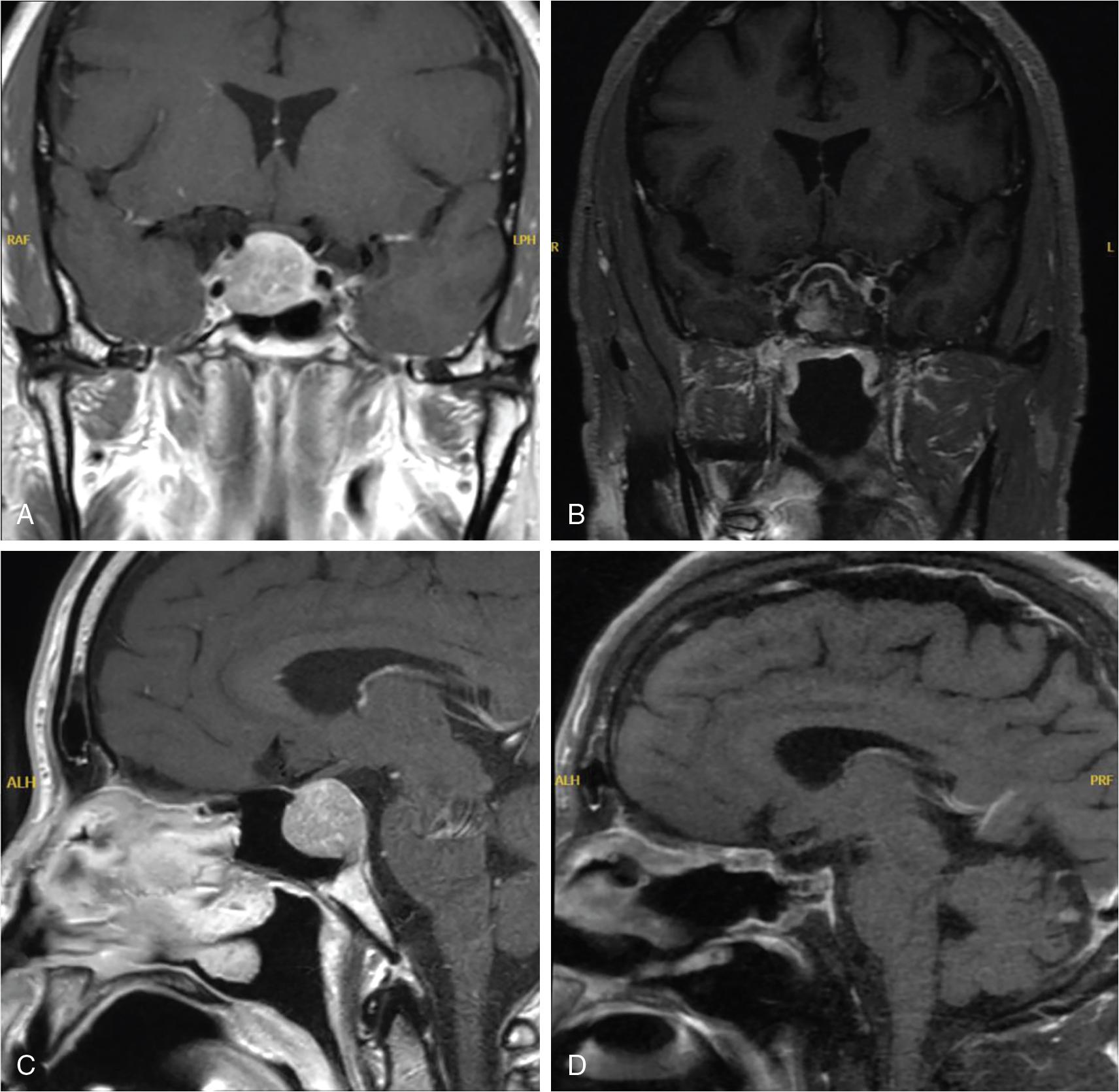 Fig. 38.2, T1-weighted magnetic resonance imaging with contrast showing preoperative macroadenoma ( A, coronal; C, sagittal) and postoperative site with healed nasoseptal flap ( B, coronal; D, sagittal).