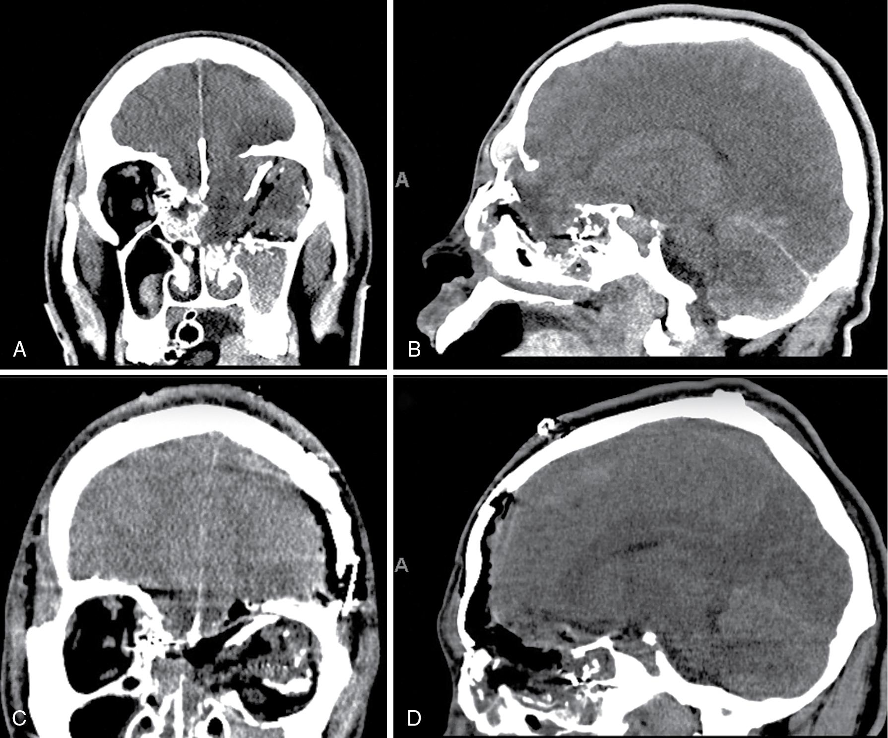 Fig. 14.1, A 19-year-old man presented with a Glasgow Coma Scale score of 11 (E4V2M5) after a gunshot wound to the head that traversed from the right nasion across the left ethmoids to the left orbital apex and left temporal lobe. He was initially managed with intracranial pressure bolt monitor, but on day 9, he developed cerebrospinal fluid (CSF) rhinorrhea. Computed tomography scan showed a large left ethmoid defect with encephalocele ( A and B ). A lumbar drain was placed before a transbasal approach for repair with pericranial graft transposition ( C and D ), and the drain was opened continuously for 3 days then removed, with resolution of the CSF leak. On follow-up, the patient remained blind in the left eye but was otherwise neurologically well without rhinorrhea.