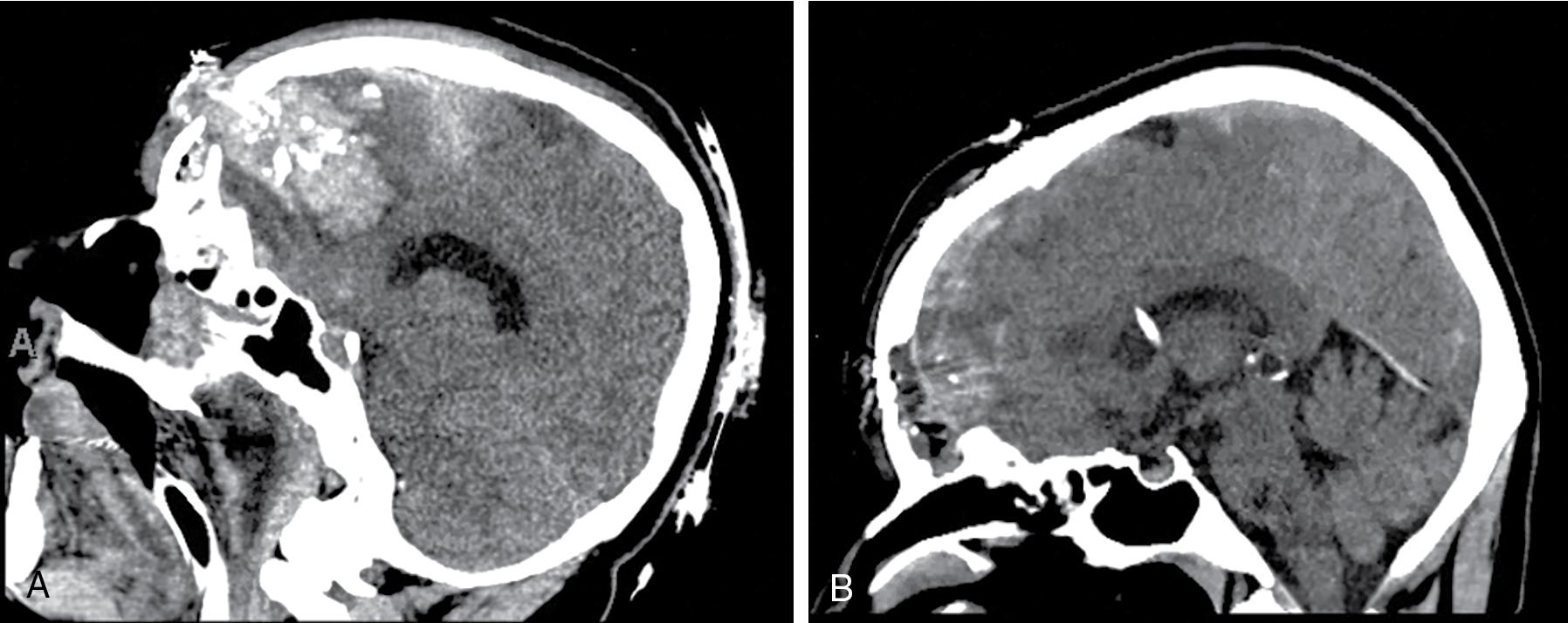 Fig. 14.2, A, A 48-year-old woman presented after a gunshot wound to the head involving the inner and outer tables of the frontal sinus as well as bilateral frontal lobes, including Broca’s area. She was taken emergently to the operating room because of an expanding intraparenchymal hematoma, at which time the frontal sinus was also repaired using a pericranial transposition graft. An external ventricular drain (EVD) was placed for postoperative intracranial pressure monitoring and diversion of cerebrospinal fluid (CSF). B, The EVD was removed on postoperative day 3, and the patient was discharged to rehabilitation soon after, with mutism and executive dysfunction but otherwise neurologically appropriate and without CSF rhinorrhea.