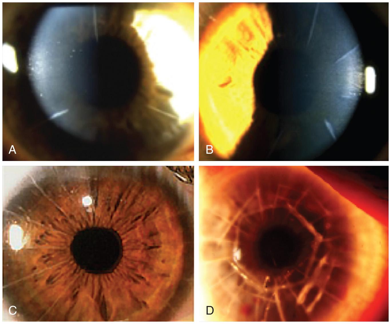 Fig. 23.2, Anterior segment images of post-RK corneas with (a) four, (b) eight and (c) sixteen radial incisions. (d) Hexagonal incisions (Hex-K) which induce hyperopia and/or correct astigmatism.