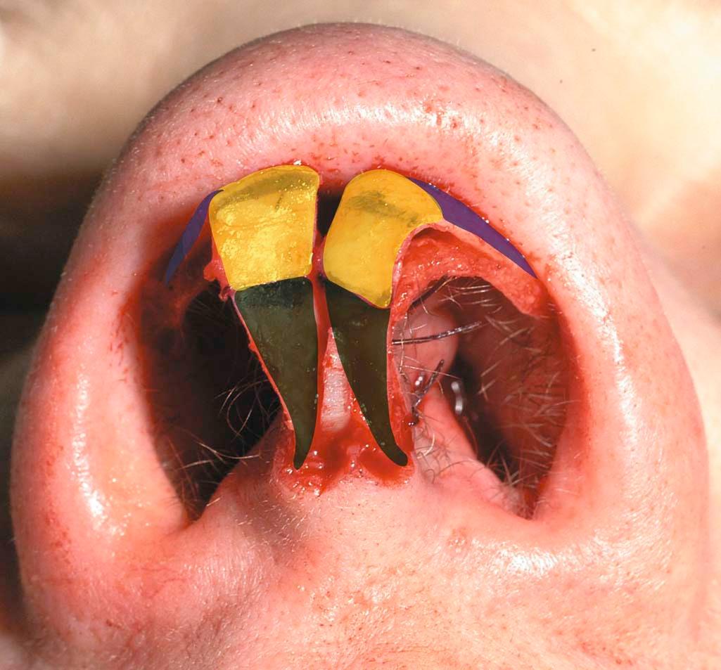 Figure 20-1, The anatomy of the tripod arch seen from the basal view. The central segment of the M-arch is termed the domal arch or lobular arch and comprises the intermediate crus and the most medial aspect of the lateral crus.