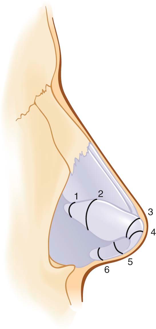 Figure 20-2, The various locations that have been described as sites to divide the lower lateral cartilages: ( 1 ) hinge area, ( 2 ) lateral crural flap, ( 3 ) Goldman maneuver, ( 4 ) vertical lobule division, ( 5 ) Lipsett maneuver, and ( 6 ) medial crural feet.