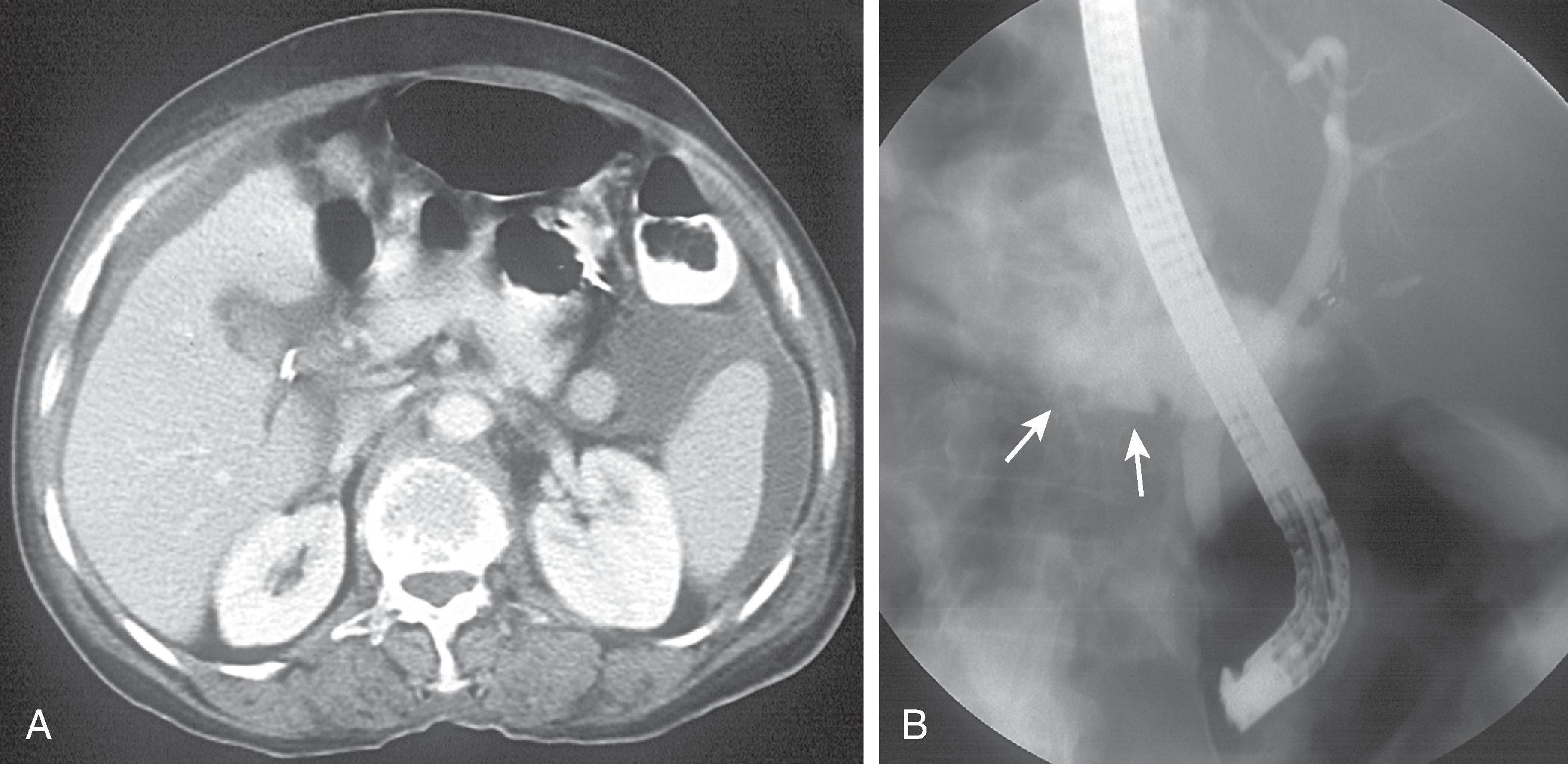 Fig. 52.1, Bile leak confirmed by endoscopic retrograde cholangiopancreatography (ERCP). (A) Computed tomography (CT) obtained 5 days after laparoscopic cholecystectomy shows free fluid in the upper abdomen mainly around the spleen and the liver and some fluid also in the gallbladder fossa, adjacent to a surgical clip. (B) ERCP after the CT study shows extensive extravasation, probably from the cystic duct remnant (arrows) .