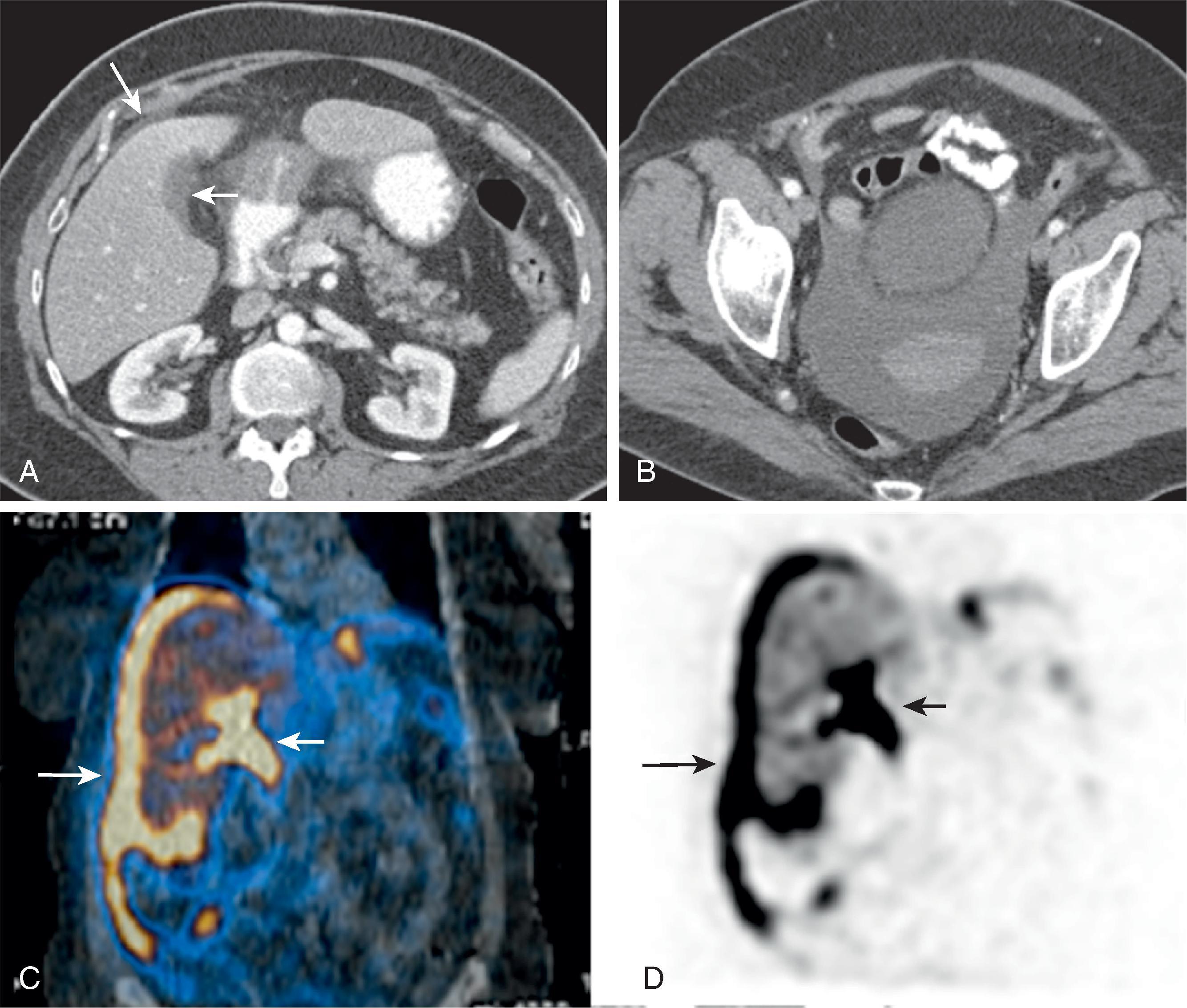 Fig. 52.2, Bile leak confirmed by hepatobiliary scintigraphy. (A) Computed tomography on second postoperative day after laparoscopic cholecystectomy in a 63-year-old woman with leukocytosis shows minute amount of free fluid around liver (long arrow) and in gallbladder fossa (short arrow) ; however, a large amount of clear fluid is seen in the pelvis (B). 99m Tc-labeled iminodiacetic acid (HIDA) by single-photon emission computed tomography (SPECT) on 12th postoperative day shows active extravasation of radiotracer in the gallbladder fossa (short arrow) and biliary ascites around the liver and in right paracolic gutter (long arrow) .