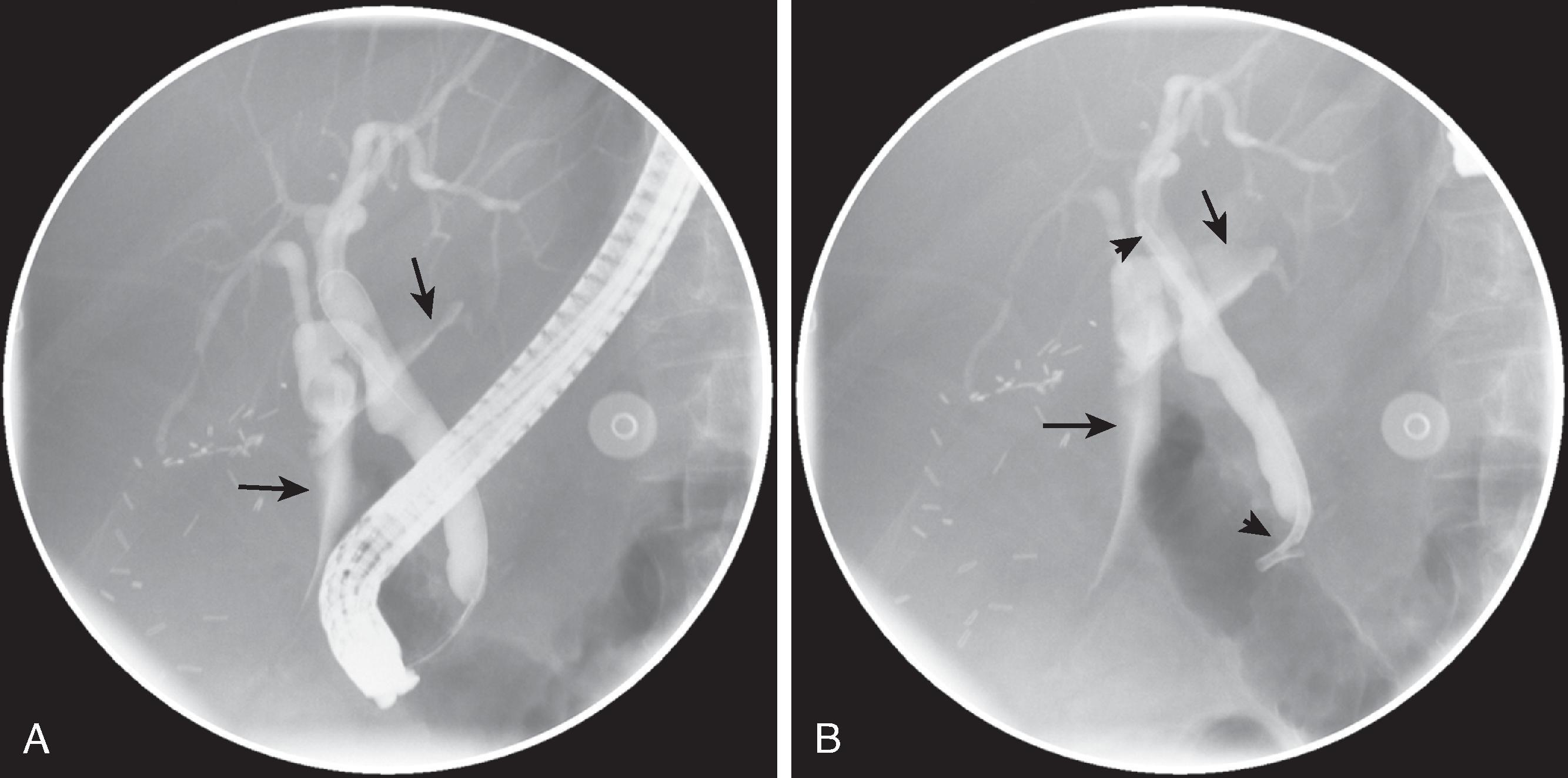 Fig. 52.3, Bile leak after cholecystectomy. (A and B) Endoscopic retrograde cholangiopancreatography (ERCP) 10 days after cholecystectomy (for gallbladder cancer) shows active extravasation of contrast material (arrows) . This was considered a “minor” leak and treated with ERCP-guided stent placement (arrowheads, B) .