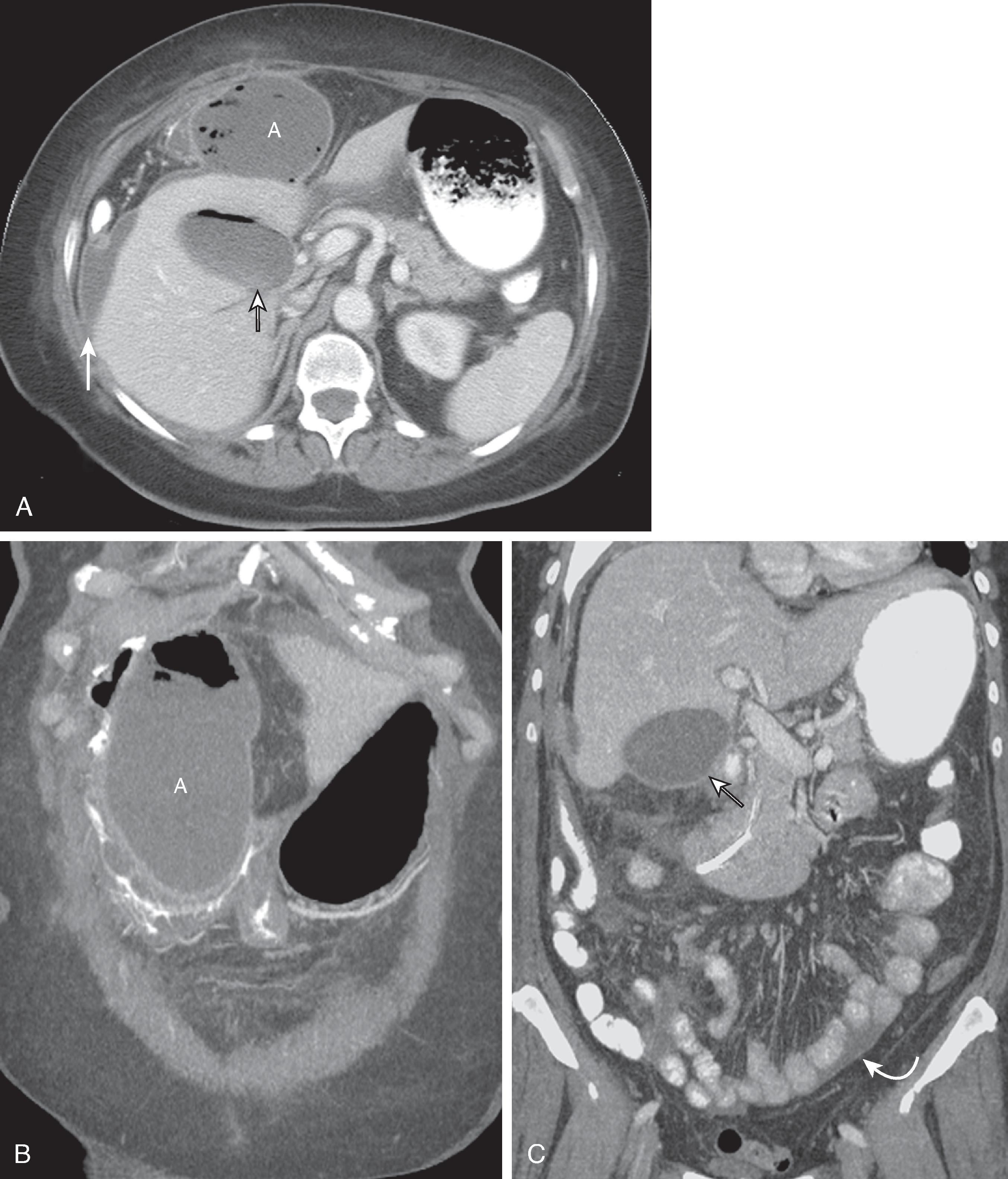 Fig. 52.4, Postoperative abscess after laparoscopic cholecystectomy. (A) Contrast-enhanced computed tomography shows gas-containing abscess anterior to liver (A) . Fluid and gas in the gallbladder fossa (short arrow) . Fluid around liver (long arrow) . (B) Coronal reformat shows full extent of abscess cavity (A) . (C) Coronal reformat shows fluid in gallbladder fossa (straight arrow) and pelvis (curved arrow) .