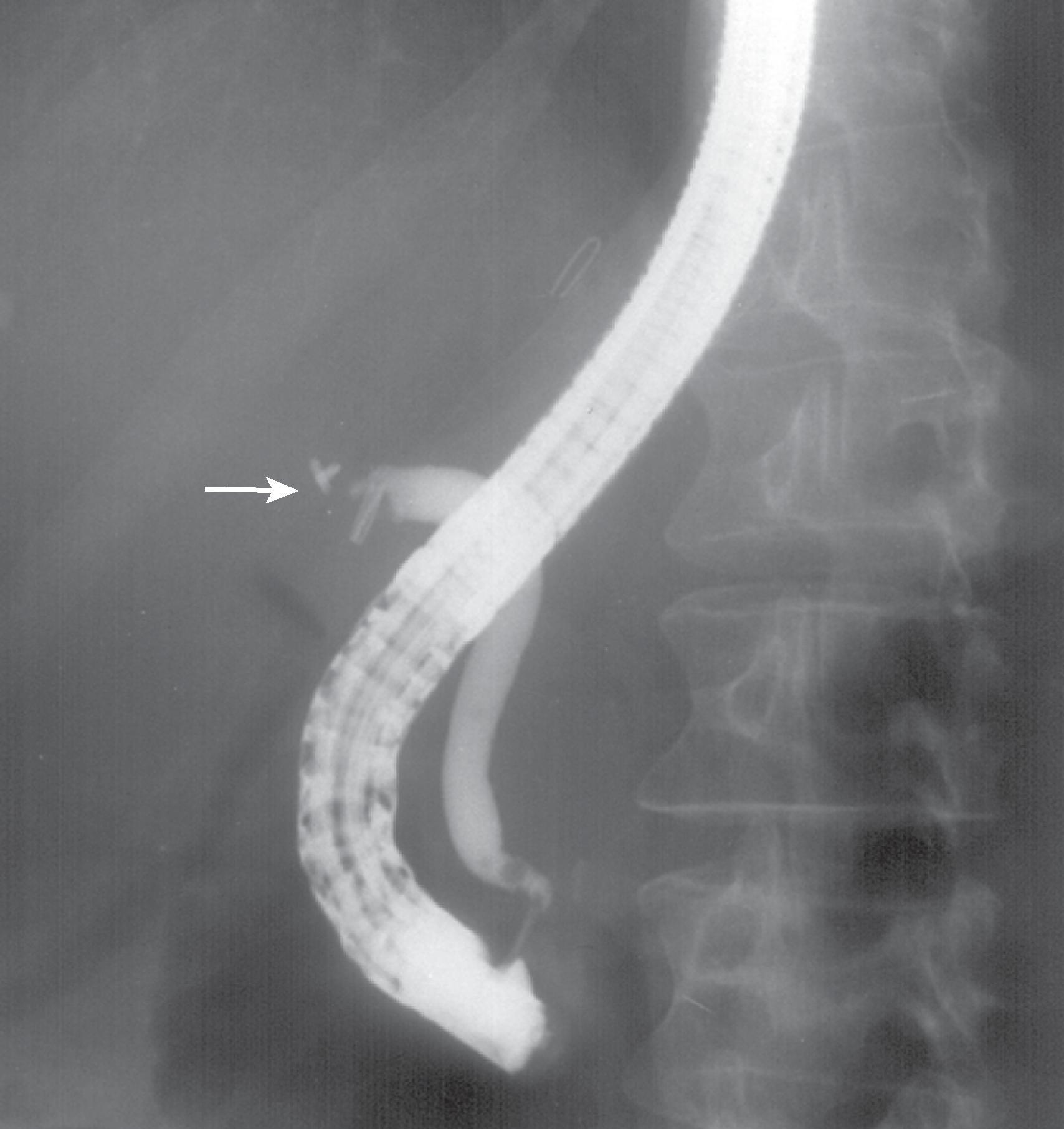 Fig. 52.5, Inadvertent ligation of common bile duct (CBD). Endoscopic retrograde cholangiopancreatography shows CBD filling to the level of surgical clips (arrow) , indicating the site where the cystic duct had originated. No contrast material is identified proximally in the bile duct.