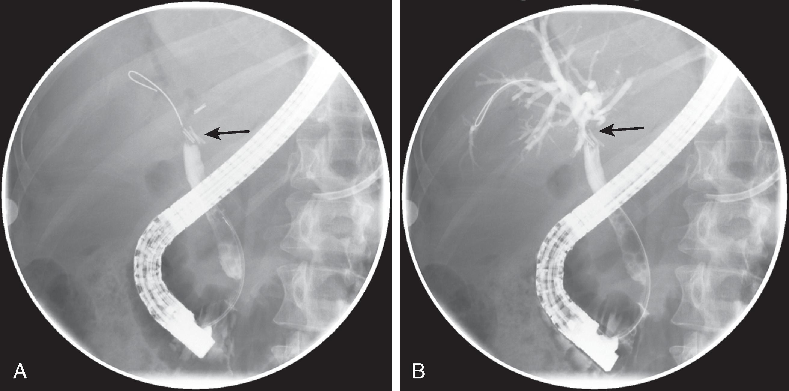 Fig. 52.6, Bile duct injury during laparoscopic cholecystectomy resulting in common bile duct (CBD) stricture. (A) Endoscopic retrograde cholangiopancreatography (ERCP) shows abrupt narrowing (arrow) of CBD at the level of cholecystectomy clips. (B) Subsequent ERCP image, with wire advanced proximal to stricture, better delineates site of stricture (arrow) .