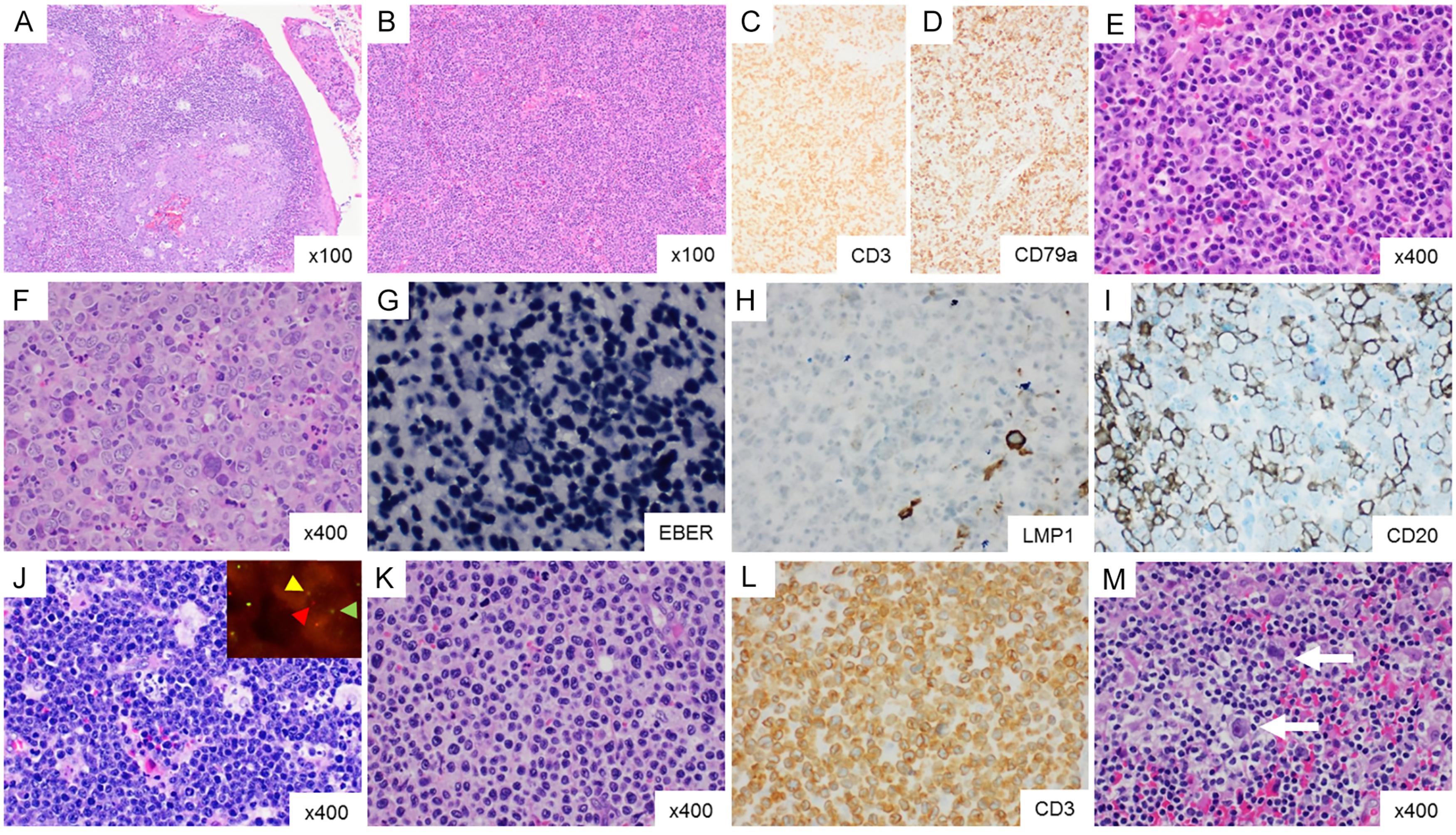 Fig. 28.3, Histopathology, immunohistochemistry, and molecular pathology of PTLD. (A) Non-destructive PTLD, follicular hyperplasia in tonsil. (B-E) Polymorphic PTLD with effacement of follicular organization (B), mixed proliferation of T-cells (CD3) and B-cells/plasma cells (CD79a) with few activated blasts but no diffuse blast infiltration (E). (F-I) Diffuse large B-cell PTLD with diffuse blast infiltration (F). Note that EBER is positive in all blast (G) while LMP1 protein is detected in only a small subfraction of blasts (H). CD20 can be expressed in all blasts or, as in this case, in a subfraction, either due to plasmablastic differentiation and/or antecedent rituximab therapy (I). (J) Burkitt PTLD with c-MYC rearrangement with FISH split signals (insert). (K, L) T cell PTLD (K) with CD3+ medium sized blasts (L). (M) Hodgkin PTLD with typical Hodgkin blasts with enlarged nucleoli (arrows).