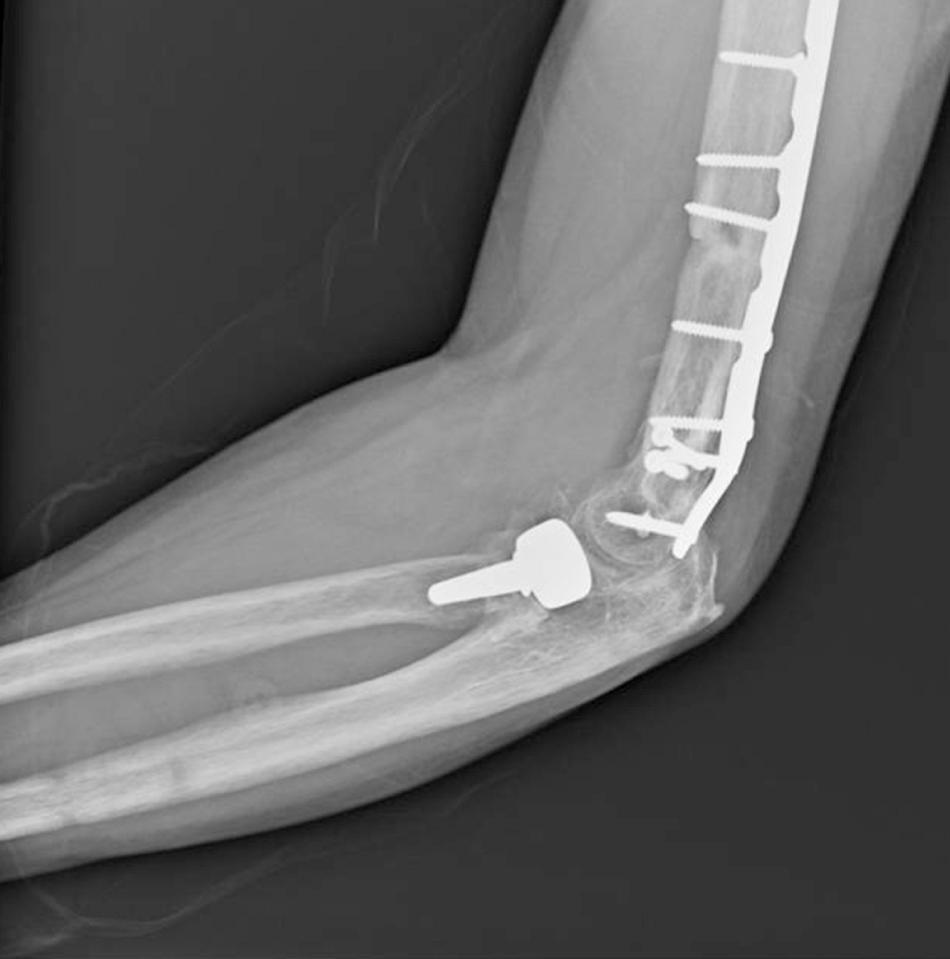 FIG 94.1, Although the Hastings-Rettig and Broberg-Morrey systems were overall both equally reliable for classification of posttraumatic elbow arthritis, reliability declined for the Hastings-Rettig classification when fracture implants were in place.