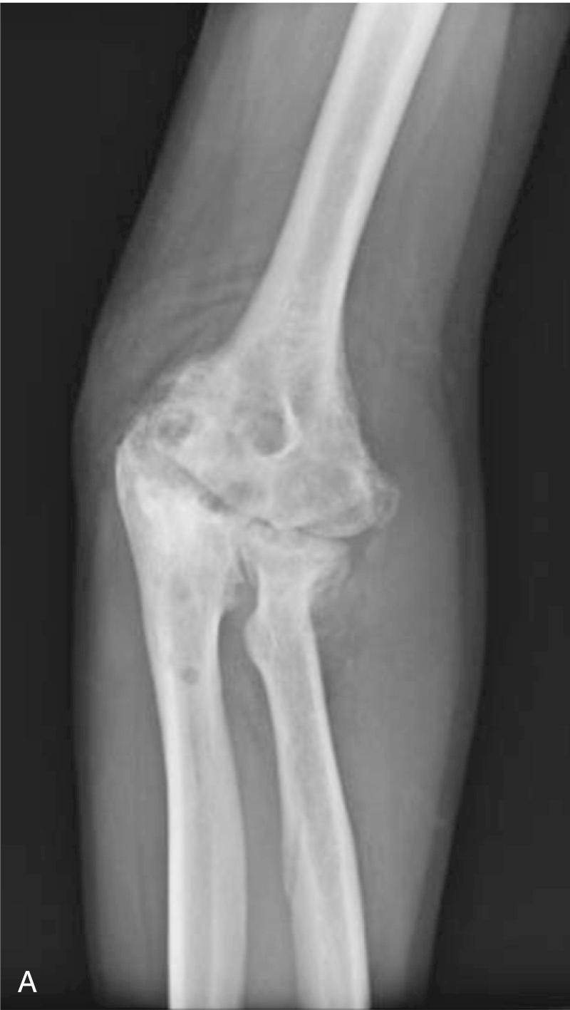 FIG 94.2, Advanced posttraumatic arthritis is marked by joint space loss but also by bony deformity and soft tissue contracture. The average patient has undergone approximately three operations before arthroplasty is considered.