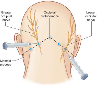 Fig. 3.15.3, Nerve block technique for the greater and lesser occipital nerves.
