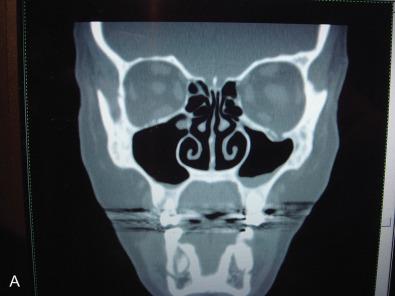 Fig. 3.15.5, CT scans document injury to the left (A) infraorbital nerve in the orbital floor, and right (B) infraorbital nerve next to a fixation plate at the infraorbital rim.