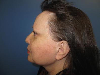 Fig. 3.15.7, This woman has had her second brow lift using an anterior hairline approach, and developed severe forehead pain and frontal headaches. Neurosensory testing demonstrated complete absence of static two-point discrimination on the right (red bars absent) and almost complete loss of sensibility on the left (blue bars), in the skin territories of the supraorbital and zygomaticotemporal nerves. The indicated treatment for this woman is to resect the damaged supraorbital and zygomaticotemporal nerves.