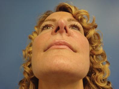 Fig. 3.15.8, This woman had bilateral upper lip and paranasal pain bilaterally after a rhinoplasty. Neurosensory testing of the cheek and upper lip bilaterally demonstrated preserved static two-point discrimination, although it required greater than normal pressure to be perceived and the static two-point discrimination threshold was abnormal. This is consistent with mild chronic compression, equal bilaterally, and observation with percutaneous massage of steroid into the nasal bone osteotomy sites was advised.