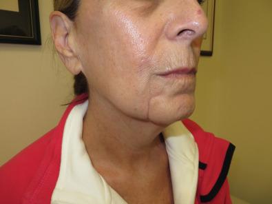 Fig. 3.15.9, This woman is 5 months following a dog bite to the lower right lip, with partial crush to the right upper jaw as well. Her neurosensory testing demonstrates a nerve regeneration pattern on the right for each of the three skin territories tested. She was advised that her pain should continue to improve with time, which it did.